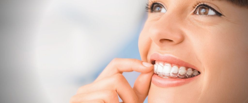 Aparelho Invisalign